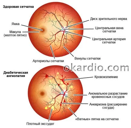 Ретината ангиопатия какво е, причини, симптоми и лечение