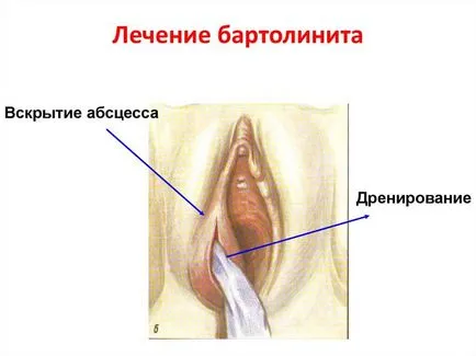Бартолини симптоми и лечение, хирургия Bartholinitis по време на бременност