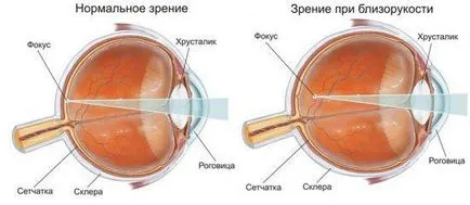 Късогледство причини, симптоми, лечение, превенция