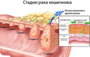 Възпалено черво - симптоми, причини, лечение, какво да правя