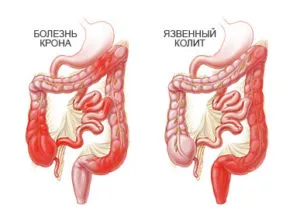 Възпалено черво - симптоми, причини, лечение, какво да правя