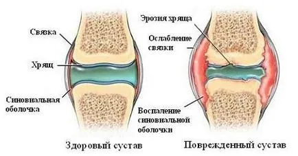 Какво става, ако много пращене ставите и какви витамини трябва да се вземат (да се направи) Какво става, ако много пращене ставите и които трябва да се вземат витамини