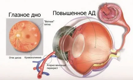 Какво е ретината ангиопатия причините и симптомите, лечението и профилактиката на патологично