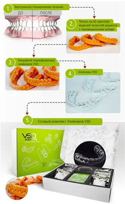 Какви са aligners
