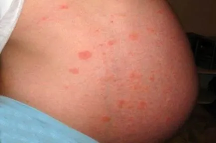 Az arc terhesség és pikkelysömör, pikkelysömör kezelésére a terhesség alatt, pszoriázis, szülés utáni, mint (psoriasis kezelésére a terhesség alatt) Mi fenyegeti a terhesség és a pszoriázis kezelések a terhesség alatt, a szülés után, mint a pikkelysömör