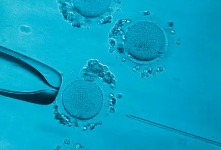 Az eco eltér ICSI és van-e különbség a jegyzőkönyvek