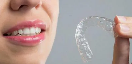 Aligners прегледи на капа за изравняване на зъбите (капа) Aligners прегледи на капа за привеждане в съответствие на зъби