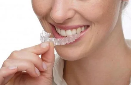 Aligners прегледи на Kappa за привеждане в съответствие на зъбите (aligners отзиви aligners за зъби изправяне aligners коментари за изравняване на мнения) Aligners прегледи на капа за привеждане в съответствие на зъби