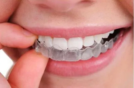 Aligners прегледи на Kappa за привеждане в съответствие на зъбите (зъбите) Aligners прегледи на капа за привеждане в съответствие на зъби