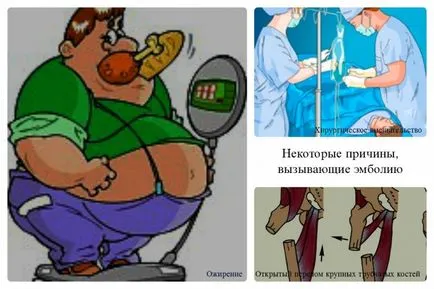 Емболия признаци, класификация, разлики емболия от кръвен съсирек, видео (емболия) Емболия признаци, класификация, разлики емболия от кръвен съсирек, видео