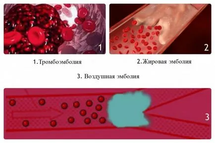 Емболия признаци, класификация, разлики емболия от кръвен съсирек, видео (блок данни от реклами, така клиент ва-кръчма-8925921048082252) Емболия признаци, класификация, разлики емболия от кръвен съсирек, видео