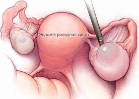 Endometrioid причини и симптоми киста
