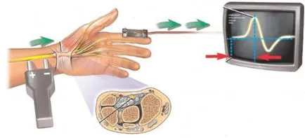 Electroneuromyographic какво е electroneuromyography лицето и крайниците