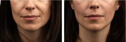 Filler teosial (teosyal)