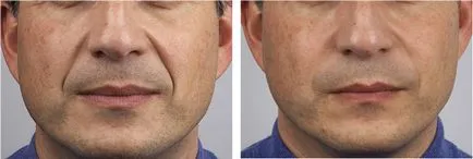 Filler teosial (teosyal)