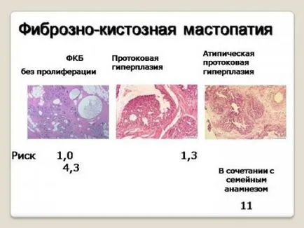 Ehopriznaki фиброциститно заболяване на гърдата