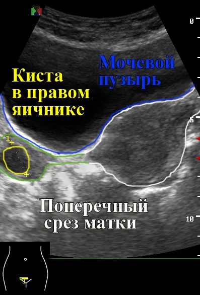 Гинекологичен ултразвук 1