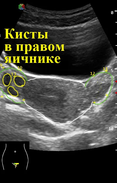 Гинекологичен ултразвук 1