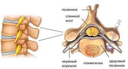 хемангиом на гръбначния стълб, което е това, което е опасно, лечение