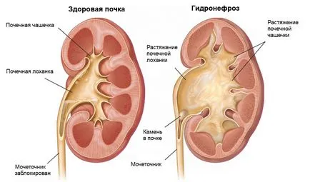 бъбрек хидронефроза, че тя се лекува без операция по време на бременност, симптоми и двупосочна