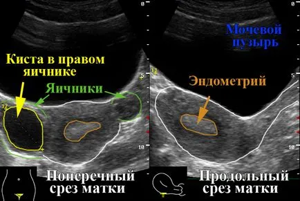 Гинекологичен ултразвук 1