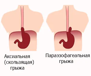 Езофагеална херния причинява лечения народни средства