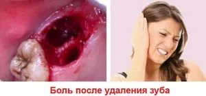 Mi a teendő, miután egy bölcsességfog eltávolítás ajánlásokat, hogyan kell eltávolítani a fájdalmat, mint öblíteni a (antibiotikumok eltávolítása után a bölcsességfogak) Mi a teendő, miután egy bölcsességfog eltávolítás ajánlásokat, hogyan kell eltávolítani a fájdalmat, mint leöblíteni
