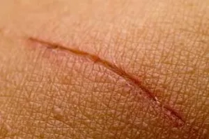Mit kell tenni, hogy ne hegek gyógyulása után