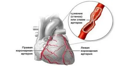 Как сърцето боли симптоми и признаци