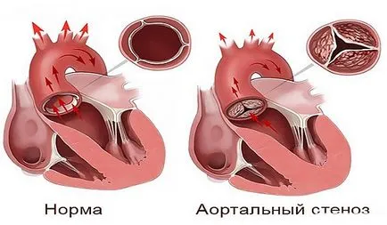 Как сърцето боли симптоми и признаци