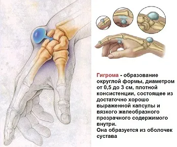 Как да се отървем от ямите по погребенията на ръка