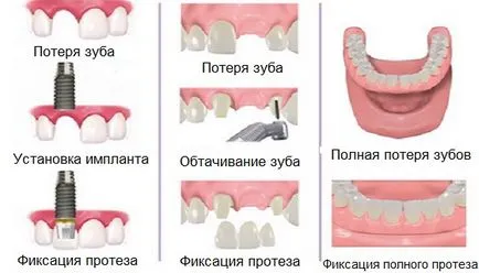 Какви са поставени зъби - дали да вмъкнете зъби болка и колко струва - Стоматологичен портал