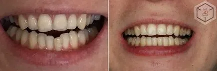 Тъй като ние тествани корекция aligners ухапване в нашия режисьор (aligners) Тъй като ние тествани корекция aligners ухапване в нашия режисьор