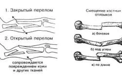 Как да се разграничи вредата от фрактура