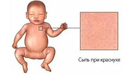 Как е рубеола при деца и възрастни
