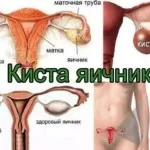 Как за лечение на остеопороза народни средства у дома (вдясно) Как за лечение на остеопороза народната медицина у нас