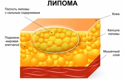 Как да премахнете мастни тумор традиционни и народни средства