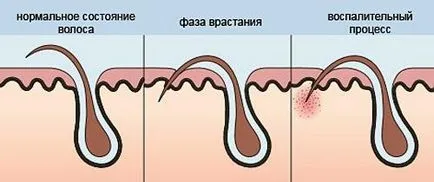 Как да премахнете навътре косми в бикини зоната