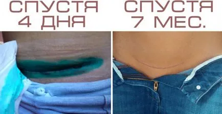 Как да се грижим за шев след цезарово сечение