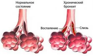 Как да се лекува кашлица при възрастни ефективни начини