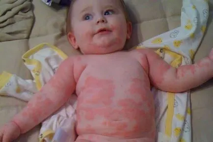 Mik csalánkiütés és mi az, kép (urticaria, mi történik) Mik csalánkiütés és mi ő, fotó