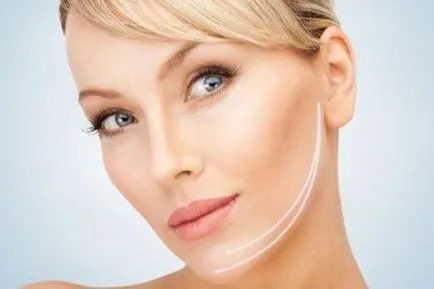 Mi emelő (facelift) faj leírása