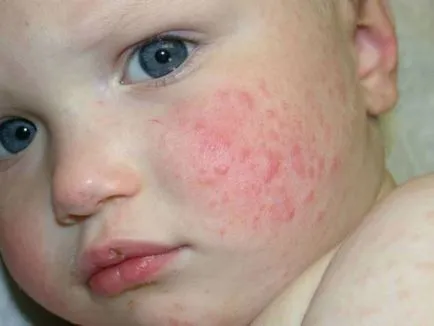 Mik csalánkiütés és mi az, kép (urticaria, mi történik) Mik csalánkiütés és mi ő, fotó