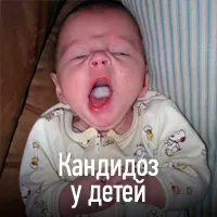 Кандидоза (млечница) - причини, симптоми, диагностика, лечение, усложнения и профилактика на гъбички