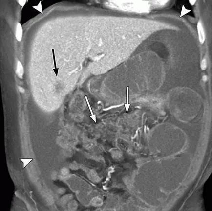 Перитонеална карциноматоза симптоми, прогноза, лечение