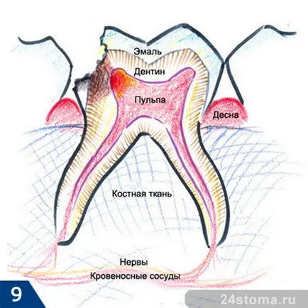 Зъбният кариес - снимка, причини, последствия