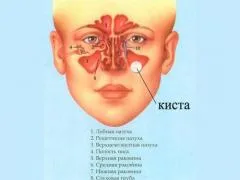 Киста на максиларните симптомите на синусите, текущи процедури