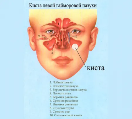 Киста на горна челюст (максиларен) синусите симптоми и лечение (симптоми) Киста на горна челюст (максиларен) синусите симптоми и лечение