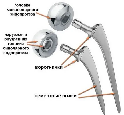 При необходимост смяна на тазобедрената става