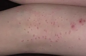 Molluscum контагиозум при деца, възрастни, симптоми, лечение се прехвърля, отстранява или не, ABC (деца) Molluscum контагиозум при деца, възрастни, симптоми, лечение се прехвърля, отстранява или не, ABC